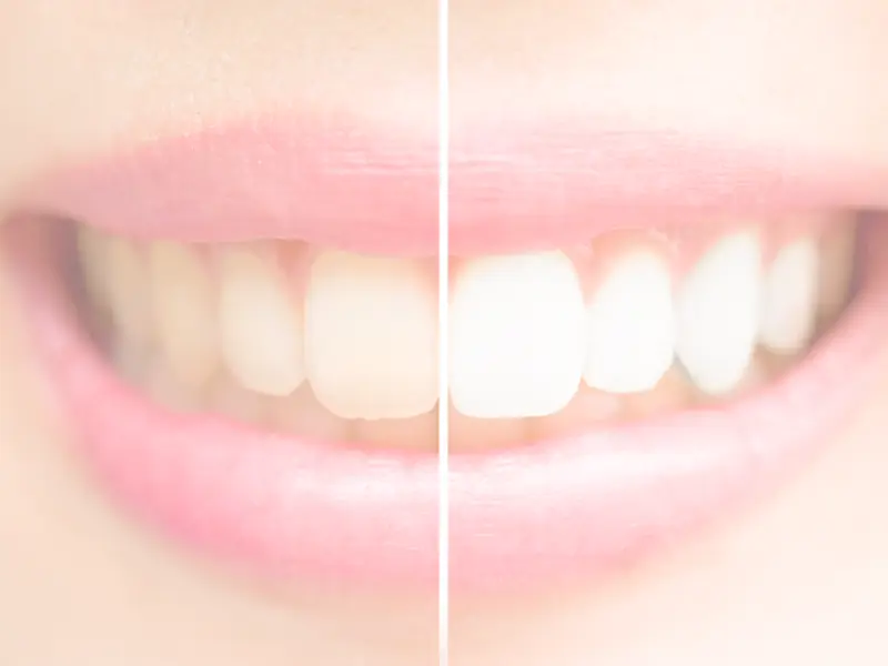 Teeth Whitening at Massage Clinic and Beauty Salon in Dunfermline