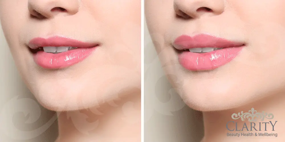 Dermal Fillers in Dunfermline at Clarity House